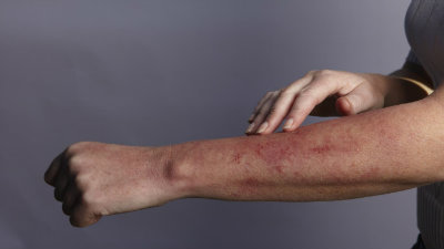 dermatitis herpetiformis elbow